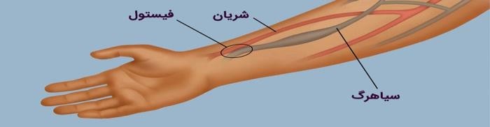 ورزشهای آموزش داده شده ی مربوط به دست فیستول دار را انجام دهیدکه شامل:
