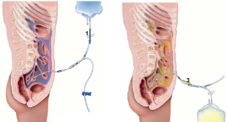 دیالیز صفاقی