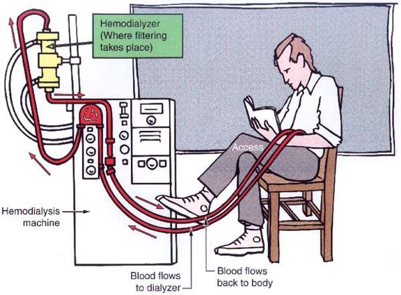 انواع دیالیز