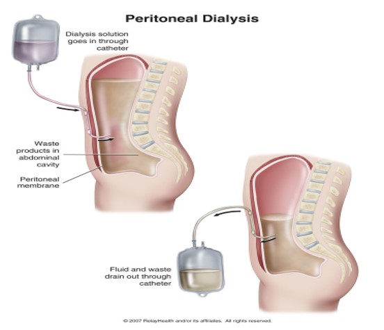 انواع دیالیز