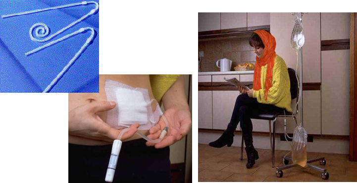 دیالیز صفاقی