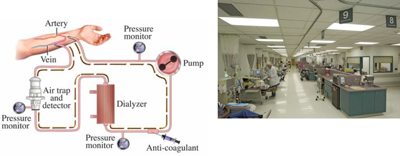 همودیالیز در مرکز بیمارستان