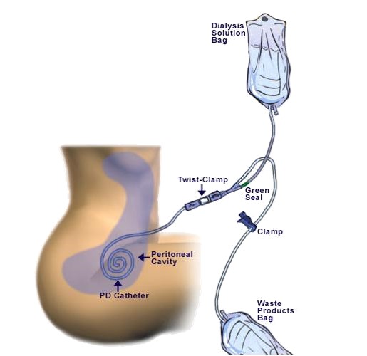 دیالیز صفاقی
