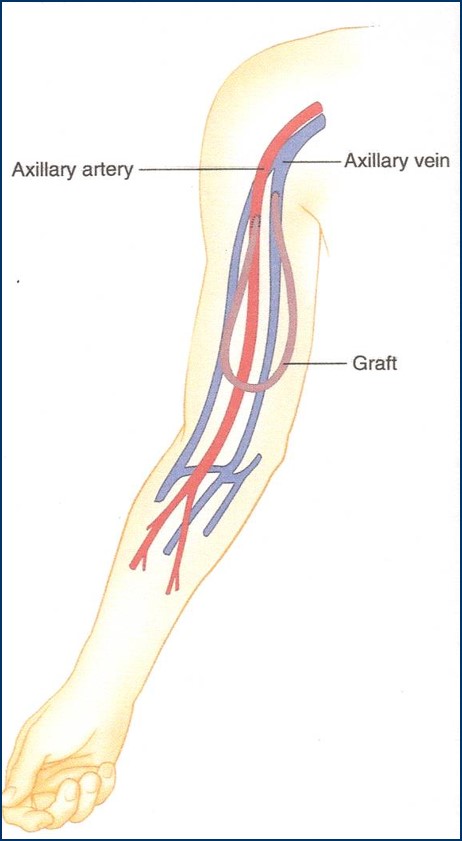 Axillary-Axillary Loop Graft