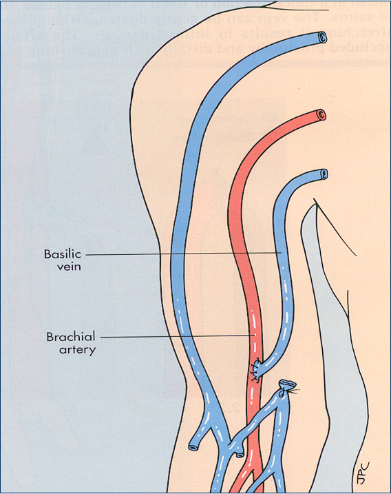 Brachiobasilic transposition