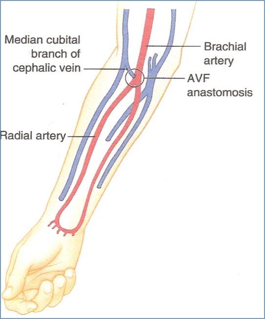 Brachiocephalic Fistula