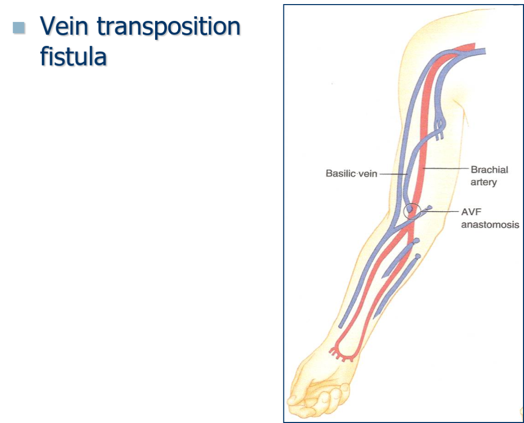 Brachiocephalic Fistula