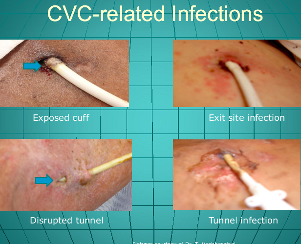 CVC-Related Infections