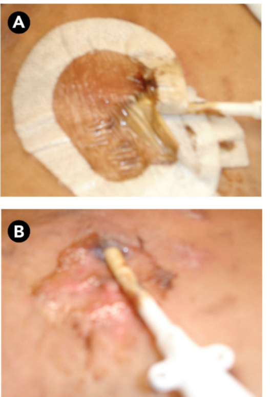 CVC-Related Infections
