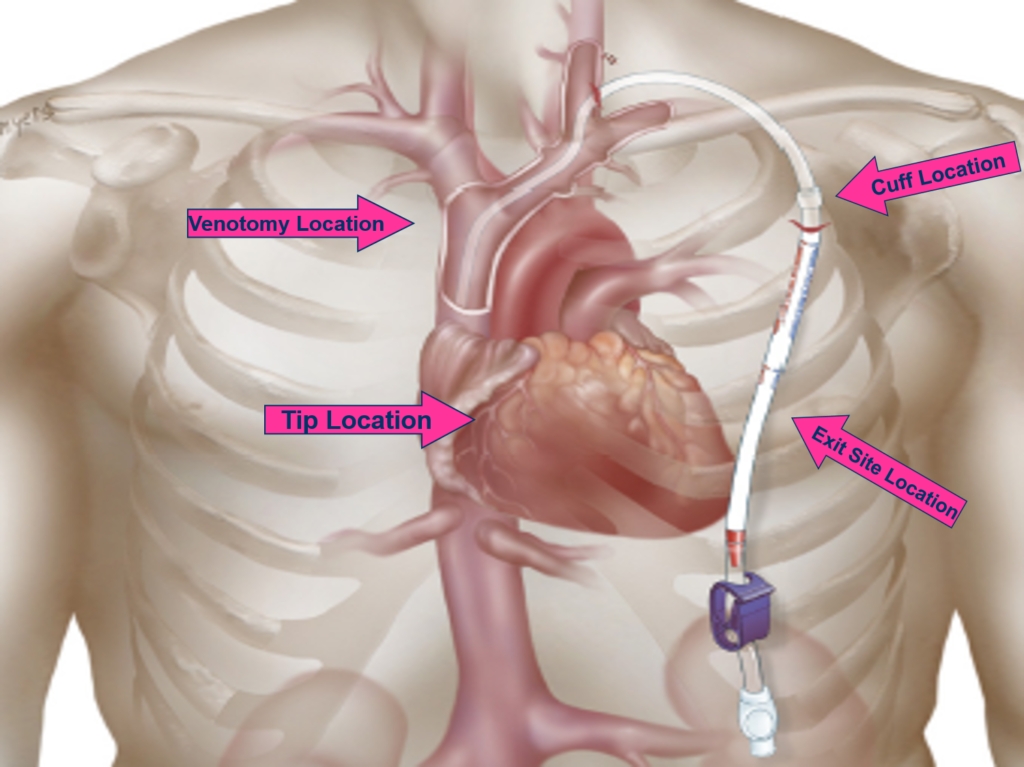Polyurethane, Polyethylene, Polythetrafluoroethylene