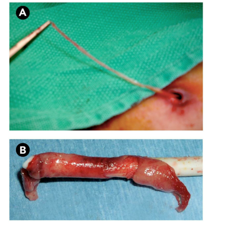 CVC-Related Infections
