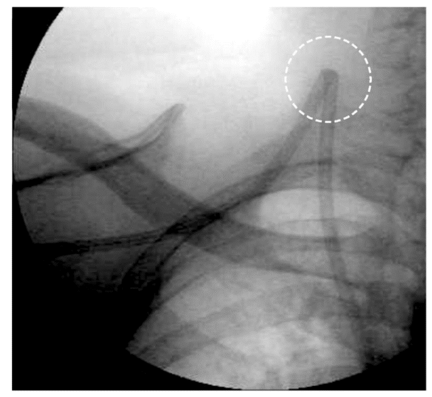 Polyurethane, Polyethylene, Polythetrafluoroethylene