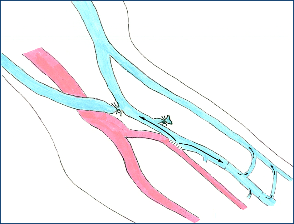 Proximal radial artery AVF
