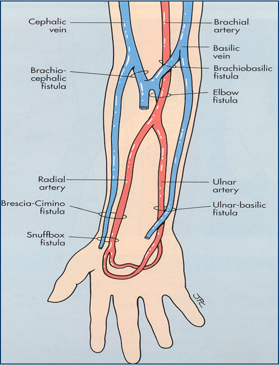 Sites for Native Fistulas