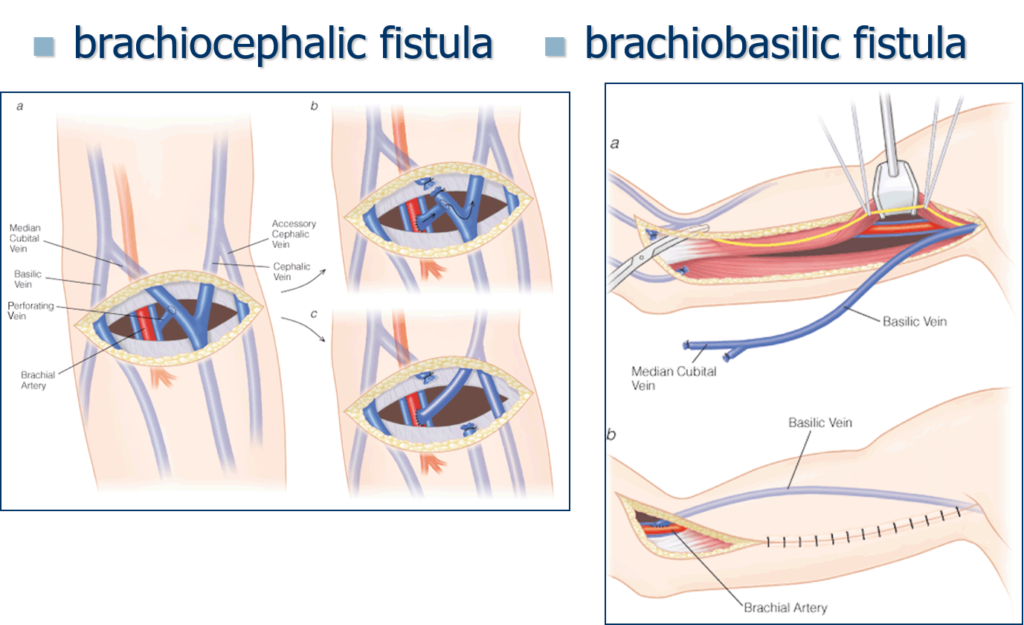 Vascular access via AVFs