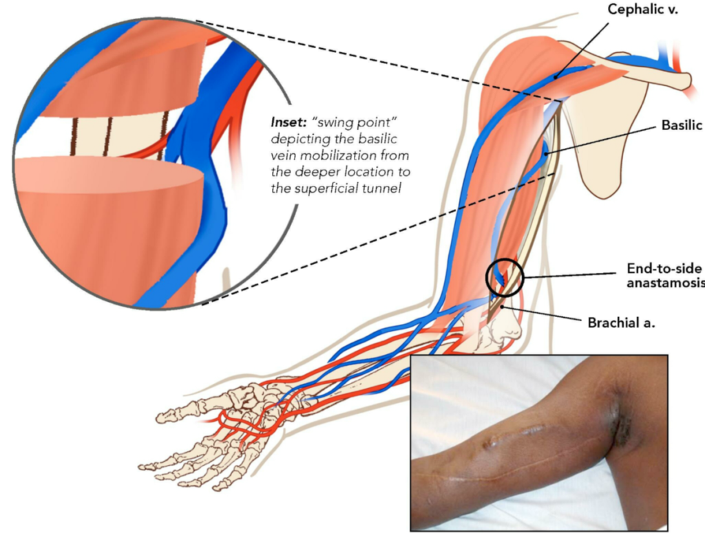 radiocephalic fistula (anatomic snuff-box)