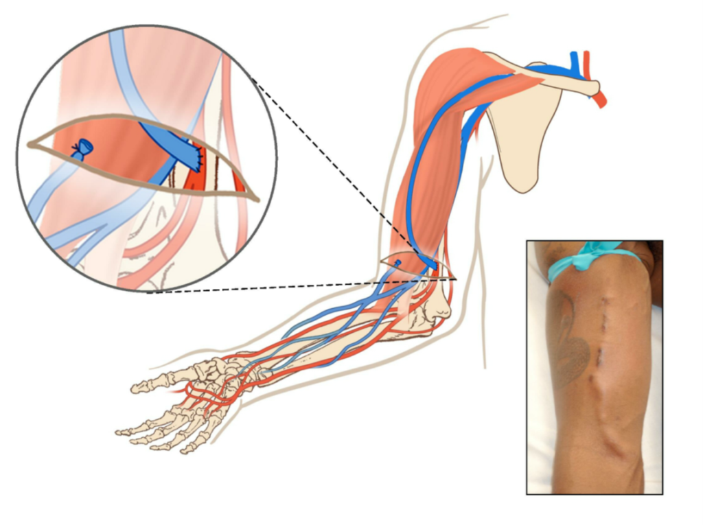 radiocephalic fistula (anatomic snuff-box)