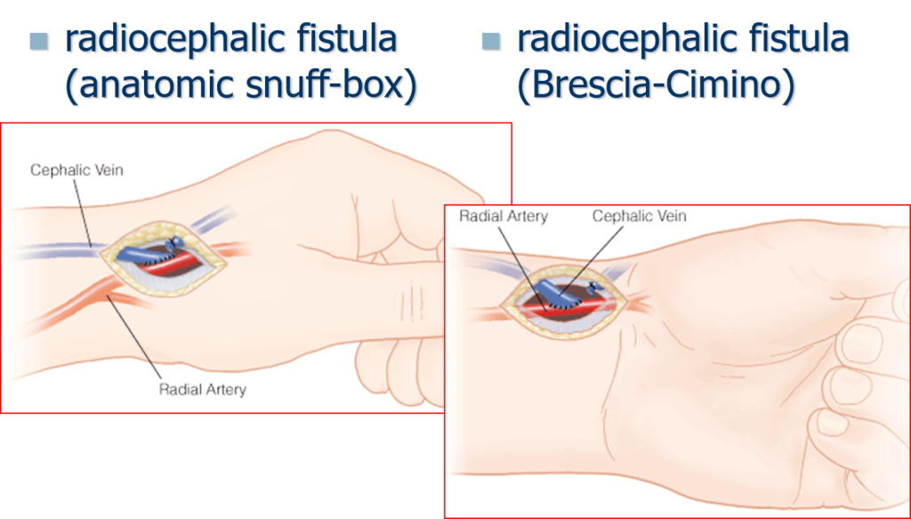 radiocephalic fistula (anatomic snuff-box)
