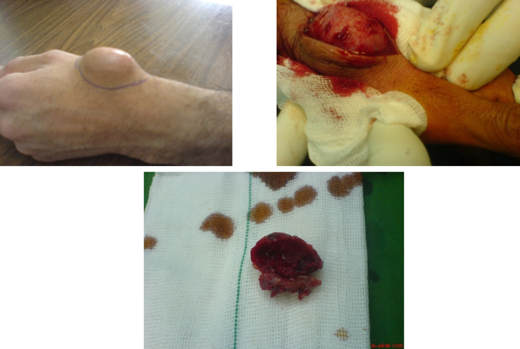 آنوریسم کاذب شریانی