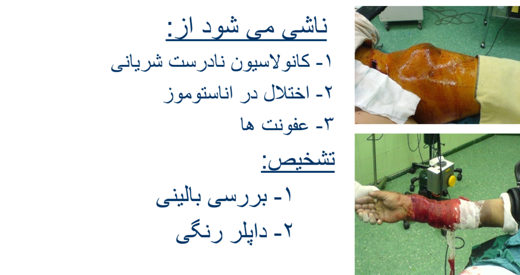 آنوریسم کاذب شریانی