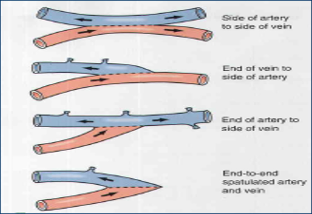 انواع روشهای تعبیه فیستول