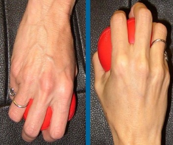 برای برجسته شدن عروق فیستولا ورزشهای زیر را انجام دهید