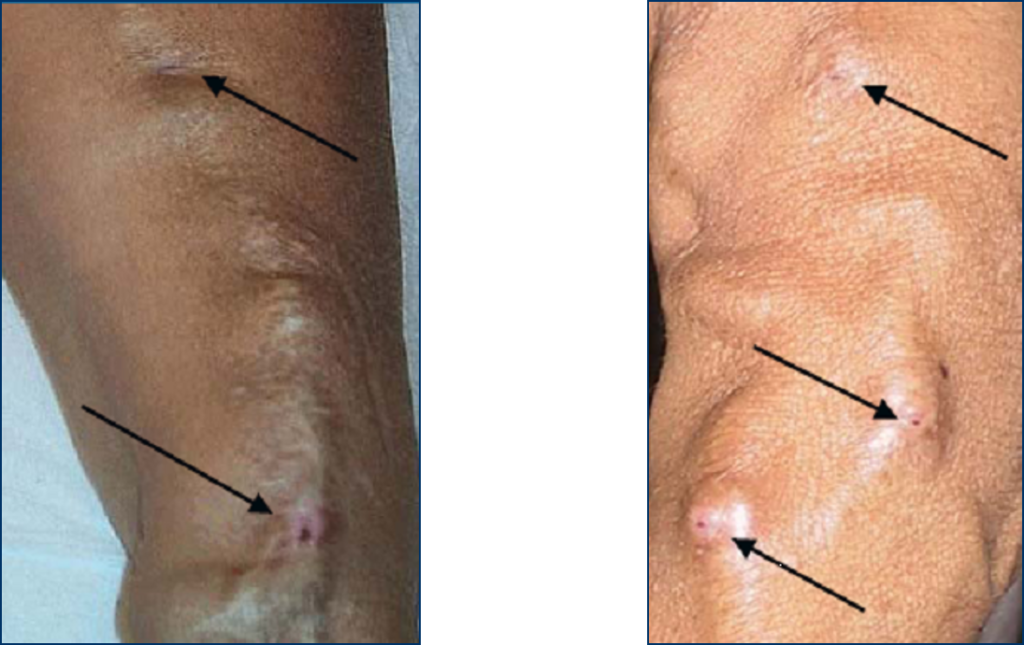 نحوه تزریق سوزن