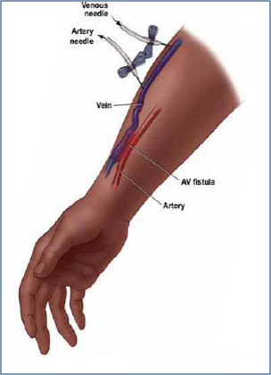 نحوه تزریق سوزن