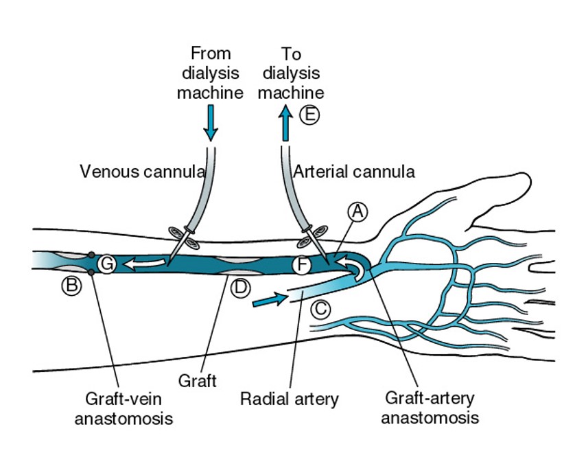 نحوه تزریق سوزن در گرافتها