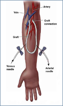نحوه تزریق سوزن در گرافتها