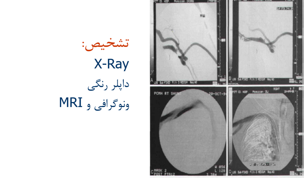 هیپرتنشن وریدی