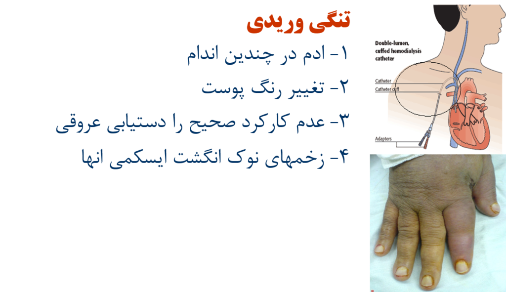 هیپرتنشن وریدی