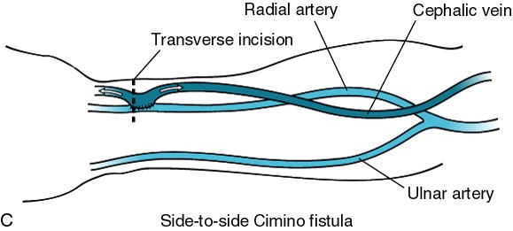 کاهش خونرسانی به دیستال اندام