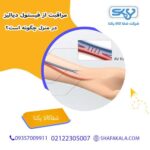 مراقبت از فیستول دیالیز در منزل چگونه است؟
