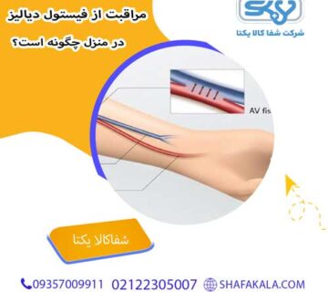 مراقبت از فیستول دیالیز در منزل چگونه است؟