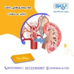 چه بیماری‌هایی باعث دیالیز می‌شوند؟